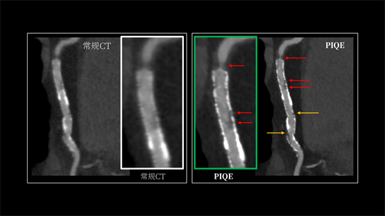 登陆中国，首款16cm光谱成像、超高清宽体CT国产上市(图4)